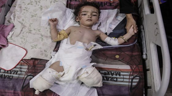 Gaza toddlers got the polio vaccine, then an Israeli bomb took their legs | Israel-Palestine conflict News